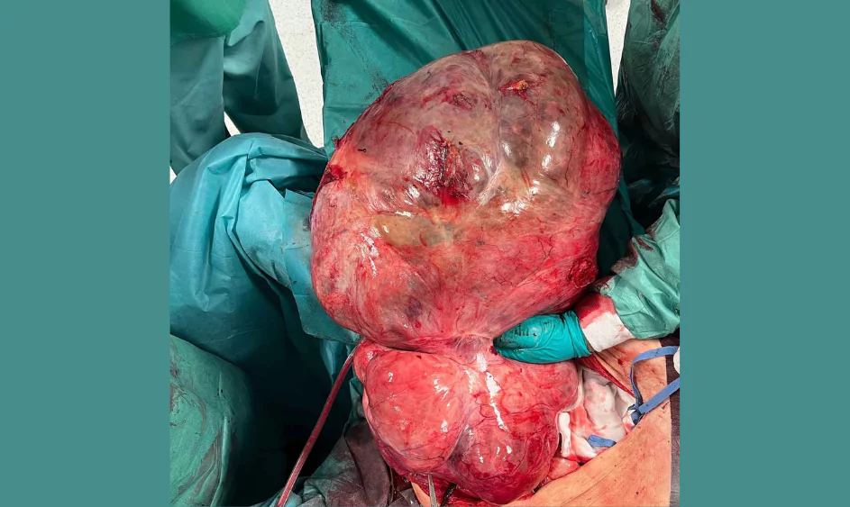Na początku marca przeprowadzono w naszym szpitalu operację pacjentki z dużym guzem macicy, ważącym aż 26 kg – to jeden z największych tego typu guzów wyciętych w Polsce.